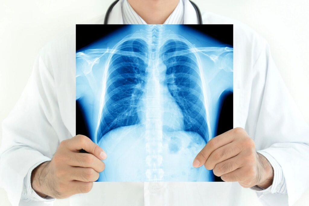 A doctor holding up an x-ray of someone 's chest.